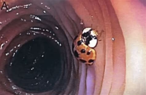 ladybug colonoscopy|ladybug in colon.